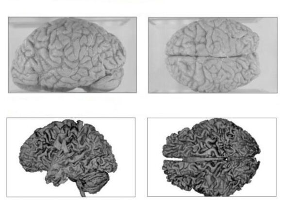 Das Gehirn eines Gesunden (oben) und das Gehirn eines Alkoholikers mit irreversiblen Folgen (unten)